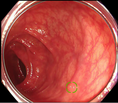 大腸ポリープ候補の四隅を囲むボックスが表示される。 大腸ポリープ候補の四隅を囲むボックスが表示される。